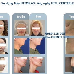 Hiệu quả sử dụng Máy Utims A3 công nghệ Hifu Centerless không đau